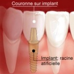 implant